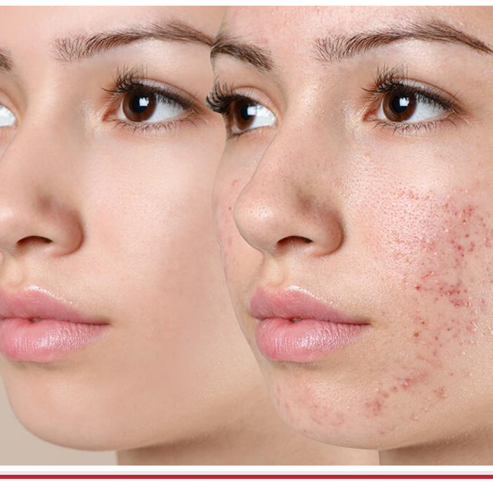 Acne Control